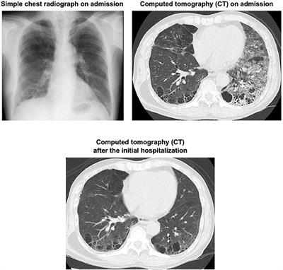 Case Report: Massive Hemoptysis From a Spontaneously Regression Inflammatory Bronchial Polyp